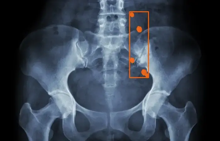 Bounding Boxes for AI in Kidney Stone