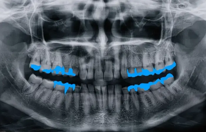 Polygons Annotation for AI in Dentistry